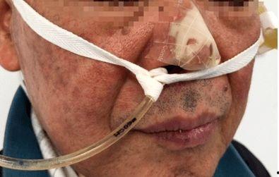 成人鼻饲管长度测量视频